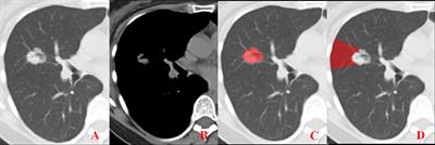 Development and Validation of a Combined Model for Preoperative Prediction of Lymph Node Metastasis in Peripheral Lung Adenocarcinoma